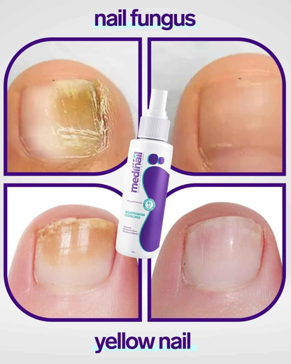 MEDINAIL - SPRAY PARA HOMGOS